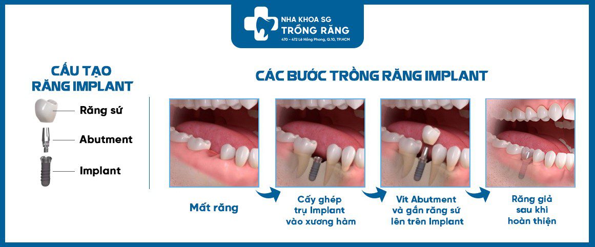Các bước trồng răng implant