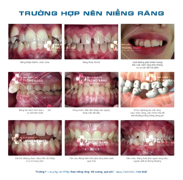 Các trường hợp cần niềng răng