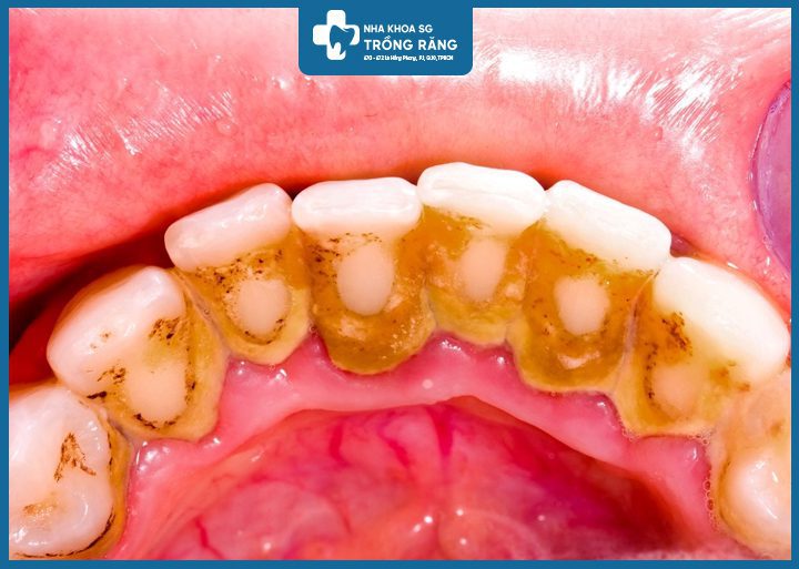Cạo vôi răng bám lâu ngày
