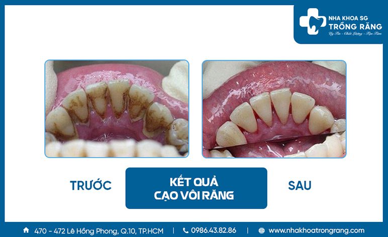 Cạo vôi răng không đau