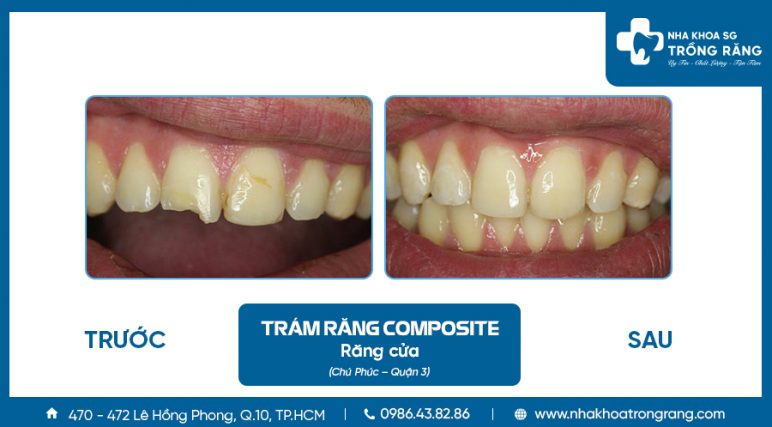 Chu Phuc tram rang cua bi gay e1627268009486 Chú Phúc trám răng cửa bị gãy