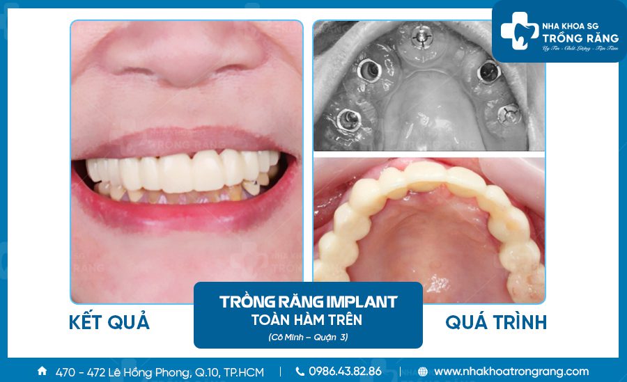 Cô Minh trồng răng implant toàn hàm trên