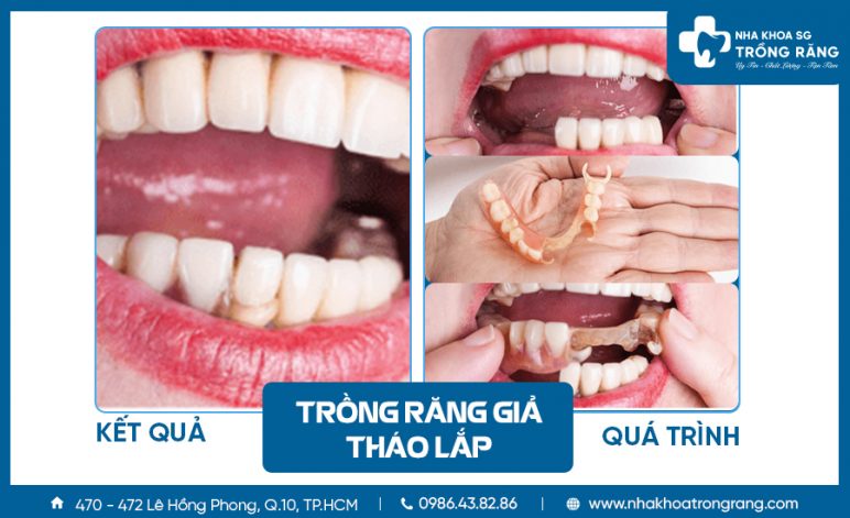 hướng dẫn trồng răng giả tháo lắp