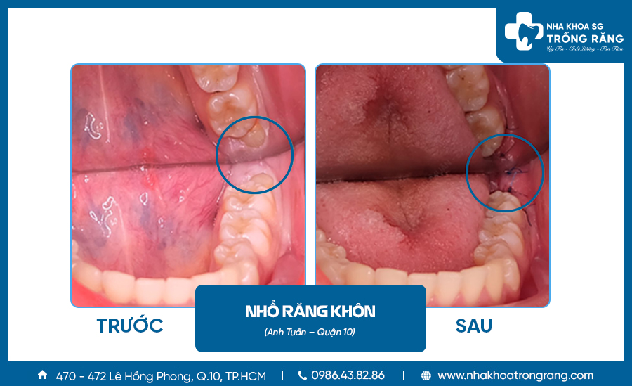 Hình ảnh nhổ răng khôn hàm dưới