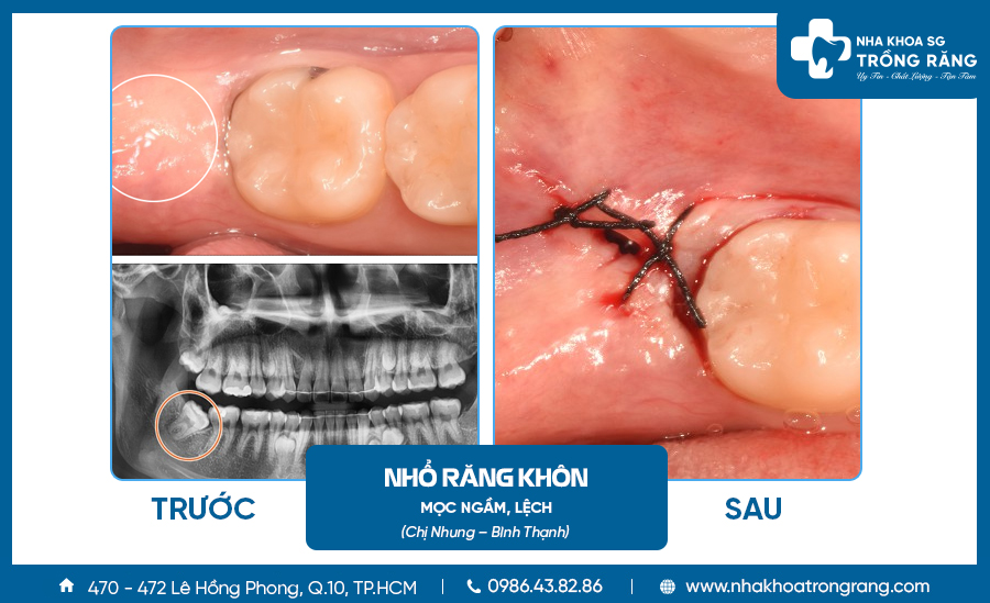 Hình ảnh nhổ răng khôn mọc lệch