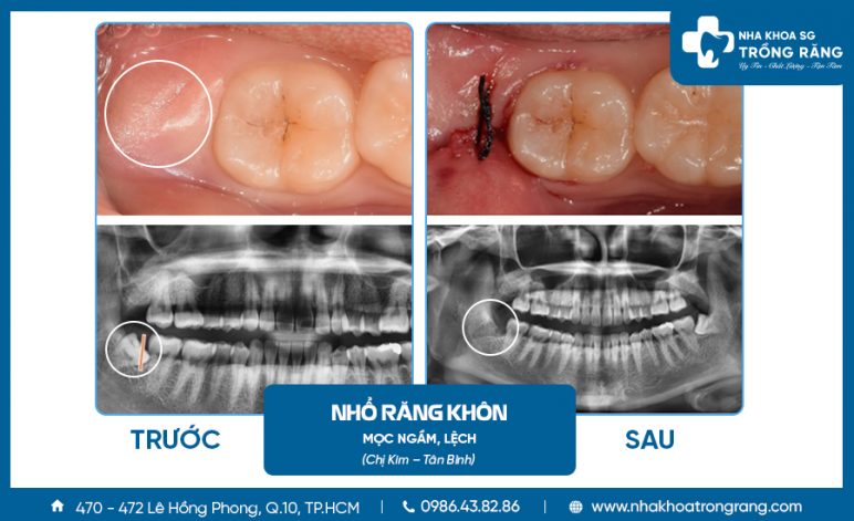 Hình ảnh nhổ răng khôn mọc ngầm