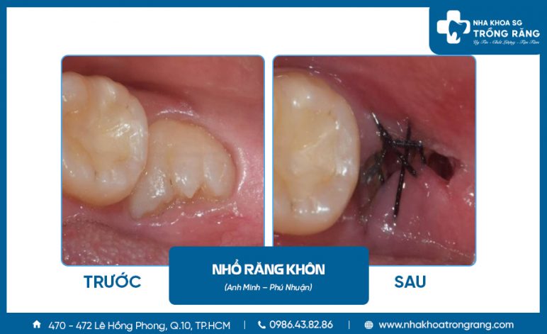 Hình ảnh nhổ răng khôn mọc nghiêng Hình ảnh nhổ răng khôn mọc nghiêng