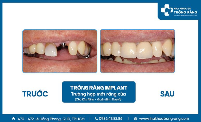 Hình ảnh sau khi trồng răng cửa Implant