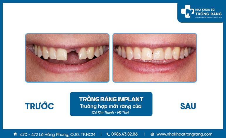 Hình ảnh trồng răng cửa Implant