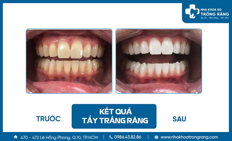 Kết quả tẩy trắng răng bị ố vàng