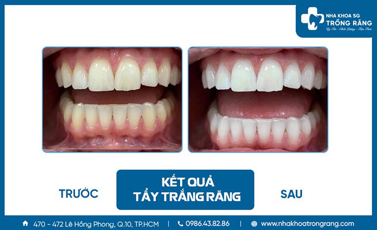Kết quả tẩy trắng răng bị vàng
