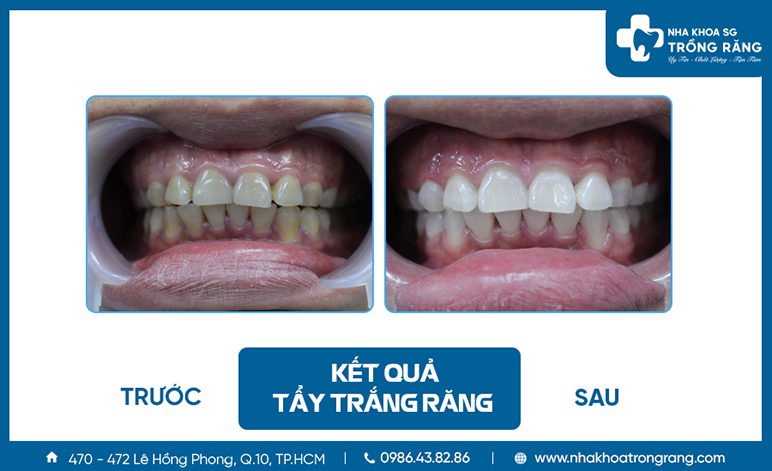 Kết quả tẩy trắng răng trước sau