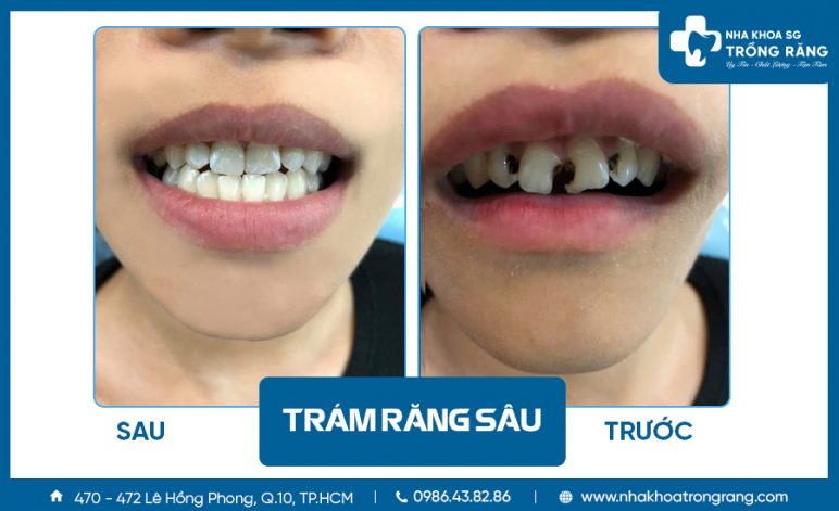 Khách hàng trám răng sâu tại nha khoa trồng răng sài gòn