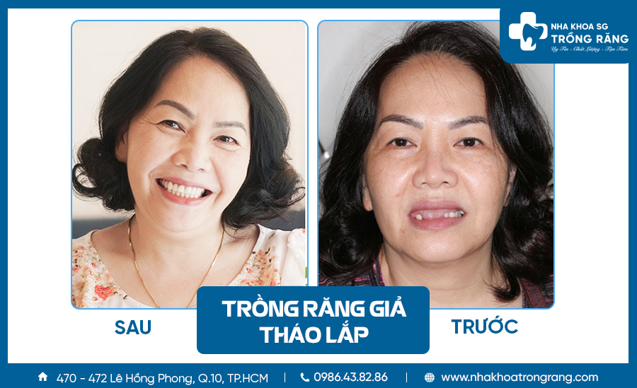 Khách hàng trồng răng giả tháo lắp