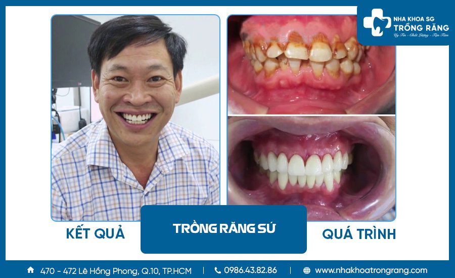 Khách hàng trung niên trồng răng sứ thẩm mỹ hai hàm