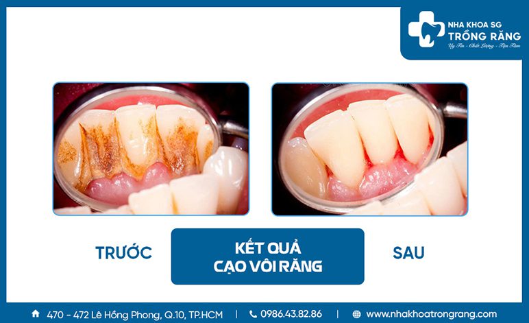 Lấy cao răng tận gốc