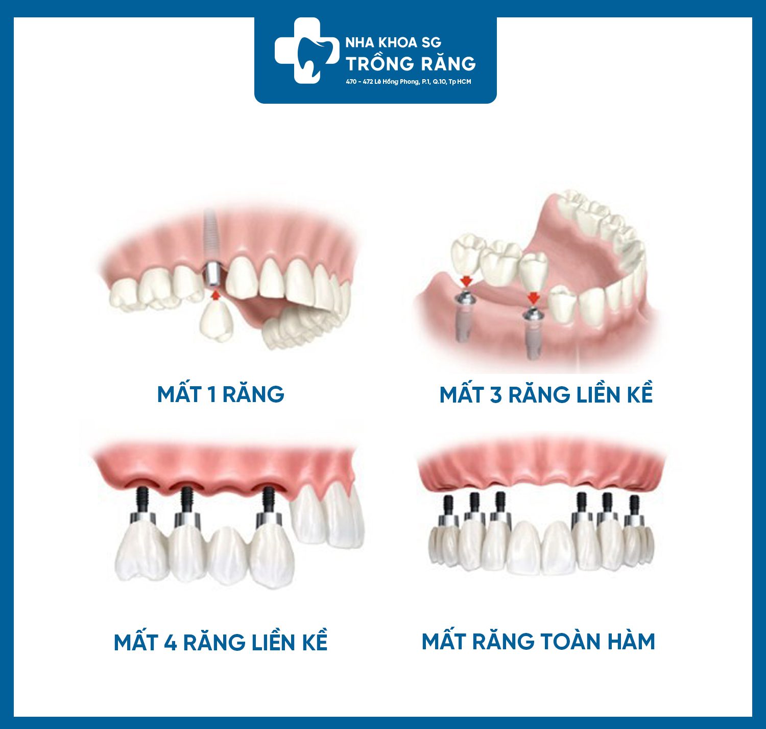 Mô phỏng các dạng trồng răng implant