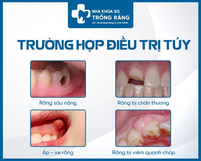 Nhung truong hop can chua tuy rang e1631508220439 Những trường hợp cần chữa tủy răng