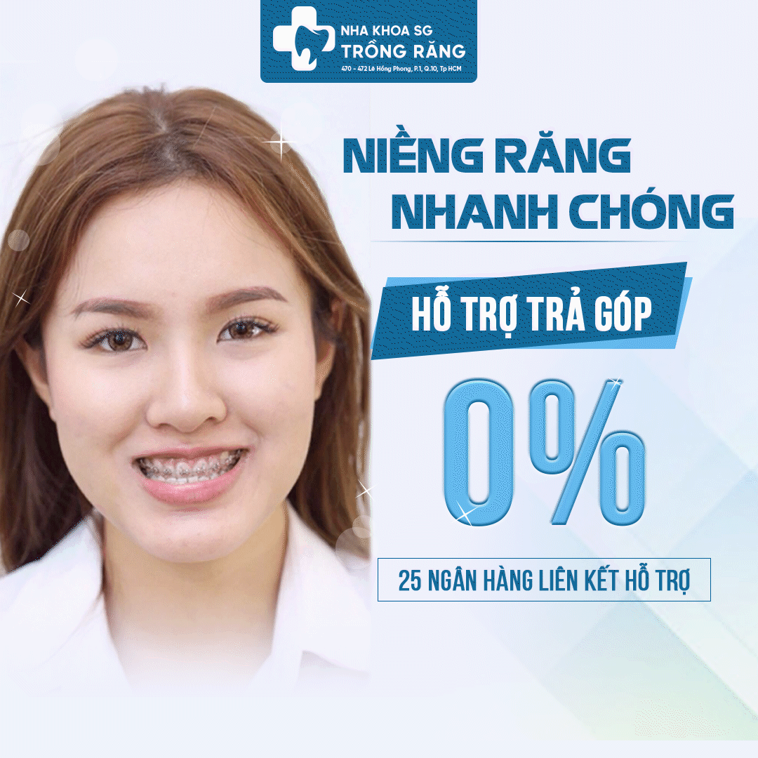 Niềng răng trả góp