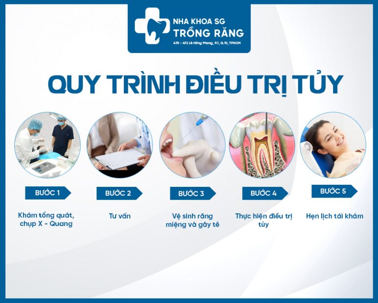 Quy trinh chua tuy rang e1631508302399 Quy trình chữa tủy răng