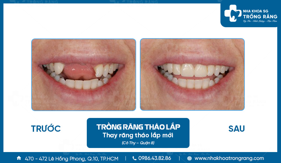 trồng răng tháo lắp Trồng răng tháo lắp