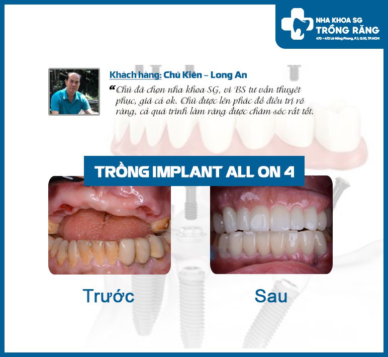 Review trong rang implant nguyen ham all on 4 Review trồng răng implant nguyên hàm all on 4
