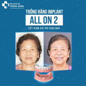 TRỒNG RĂNG IMPLANT ALL ON 2