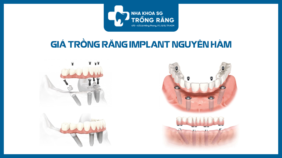 Trồng răng implant nguyên hàm