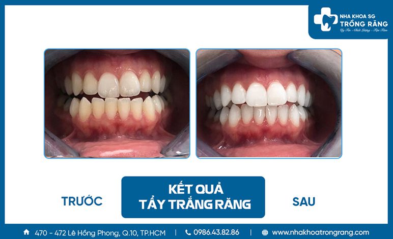 Tẩy trắng răng bị vàng tại nha khoa