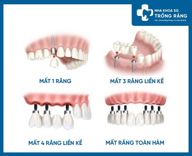 Trồng răng giả cho người già bằng Implant