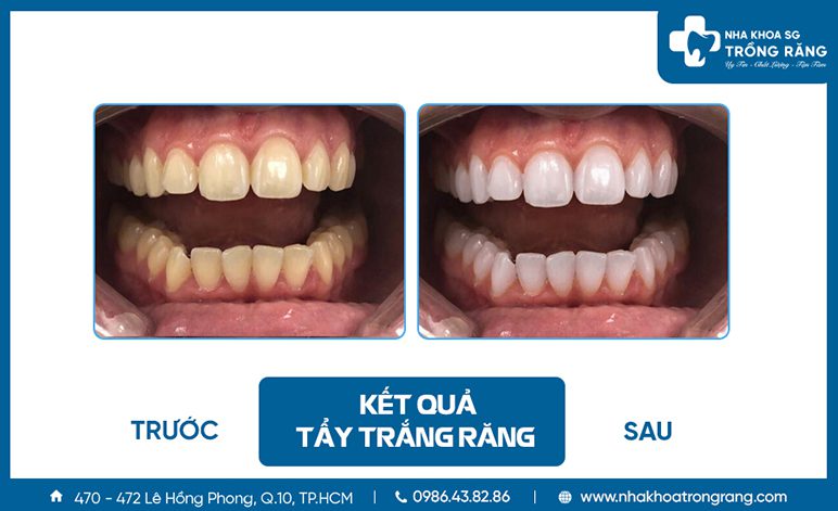 Truoc va sau khi tay trang rang Trước và sau khi tẩy trắng răng