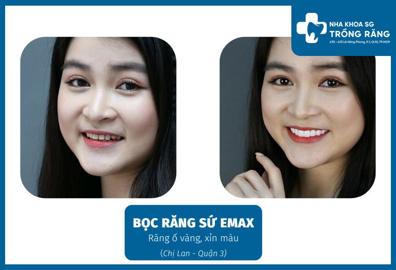 Trồng răng sứ thẩm mỹ - Ưu đãi lên đến【-50%】chi phí