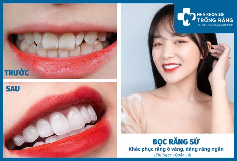 Trồng răng sứ thẩm mỹ - Ưu đãi lên đến【-50%】chi phí