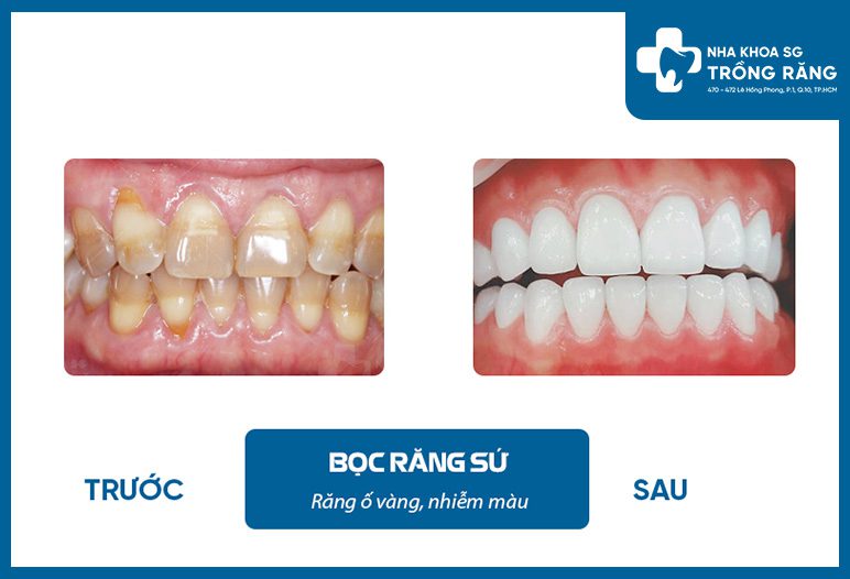 Trồng răng sứ thẩm mỹ - Ưu đãi lên đến【-50%】chi phí