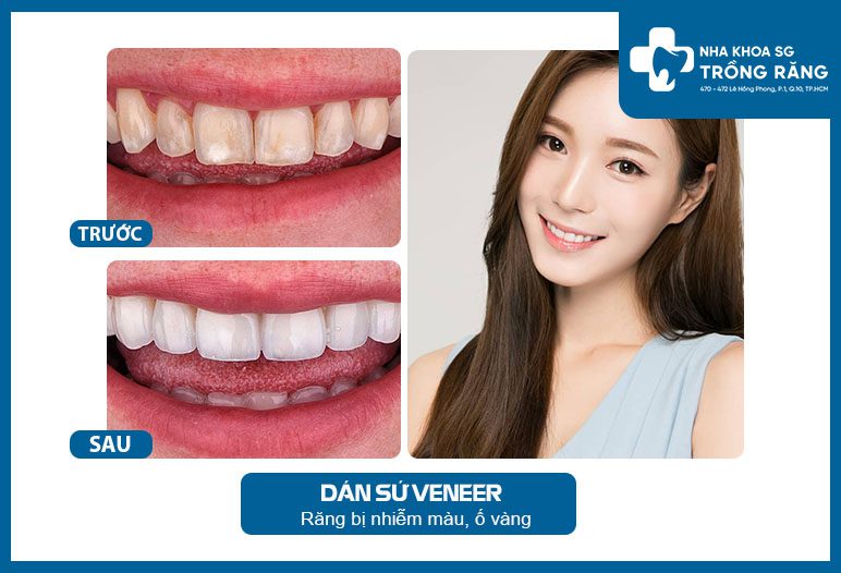 dan su veneer truoc sau dan su veneer truoc sau