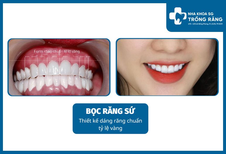 Trồng răng sứ thẩm mỹ - Ưu đãi lên đến【-50%】chi phí
