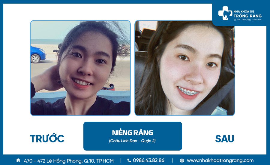 Niềng răng thẩm mỹ - Ưu đãi lên đến【-50%】chi phí