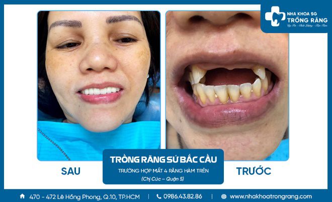 khách hàng trồng răng bắc cầu mất 4 răng cửa hàm trên