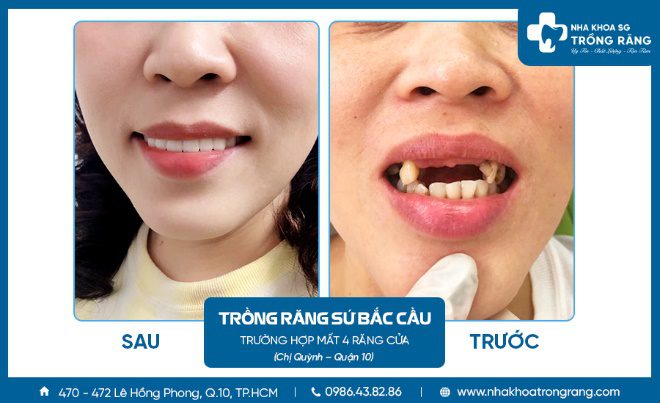 khách hàng trồng răng bắc cầu mất 4 răng cửa khách hàng trồng răng bắc cầu mất 4 răng cửa