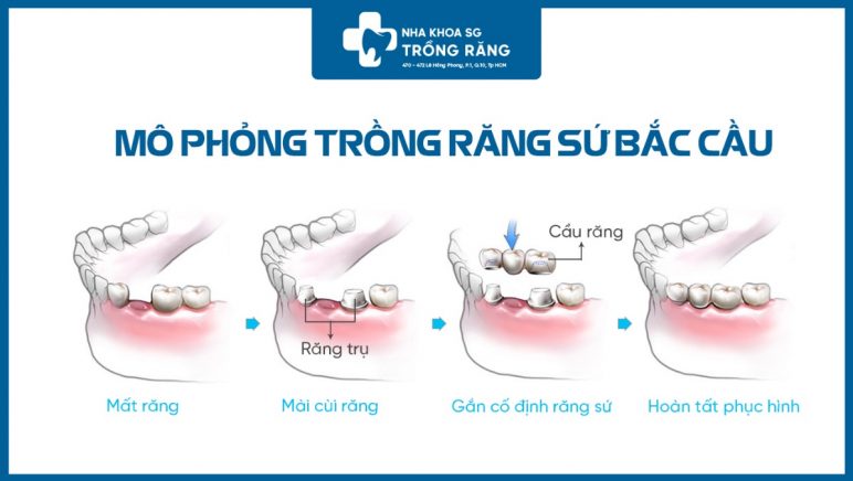 mô phỏng quy trình trồng răng bắc cầu