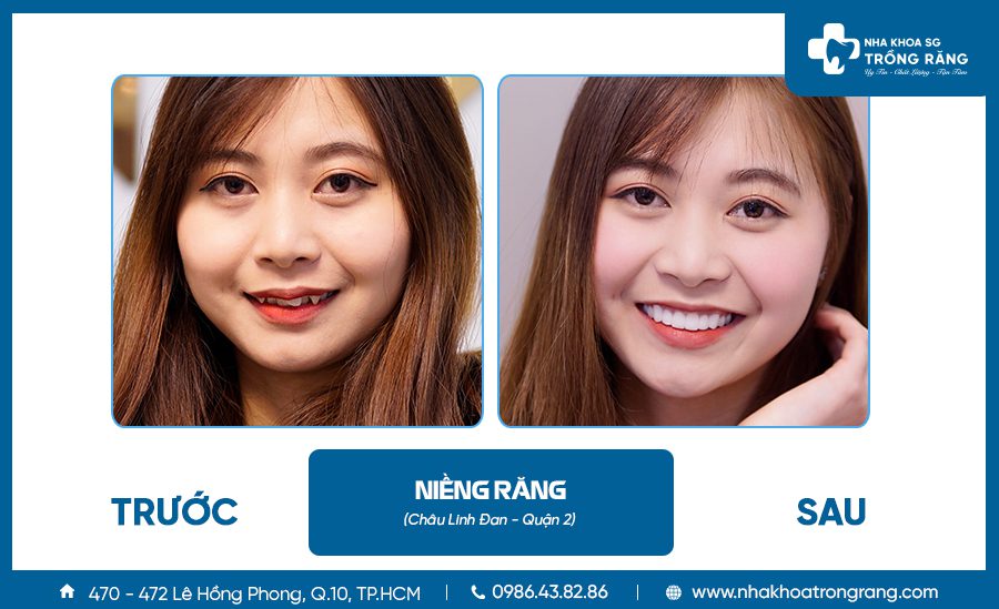 Niềng răng thẩm mỹ - Ưu đãi lên đến【-50%】chi phí