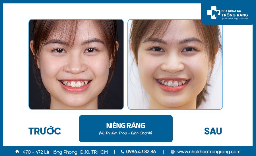 Niềng răng thẩm mỹ - Ưu đãi lên đến【-50%】chi phí