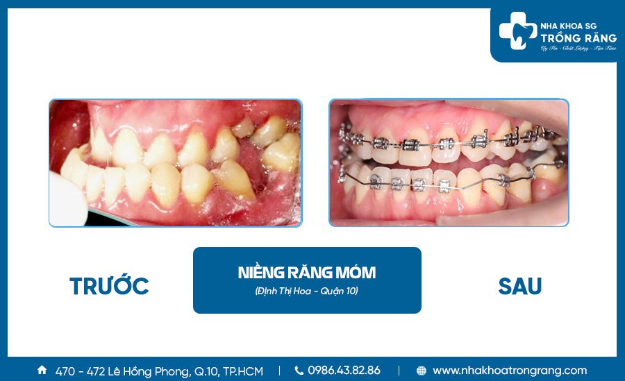 Niềng răng thẩm mỹ - Ưu đãi lên đến【-50%】chi phí