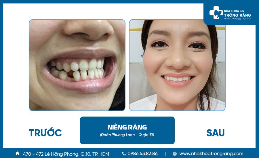 Niềng răng thẩm mỹ - Ưu đãi lên đến【-50%】chi phí