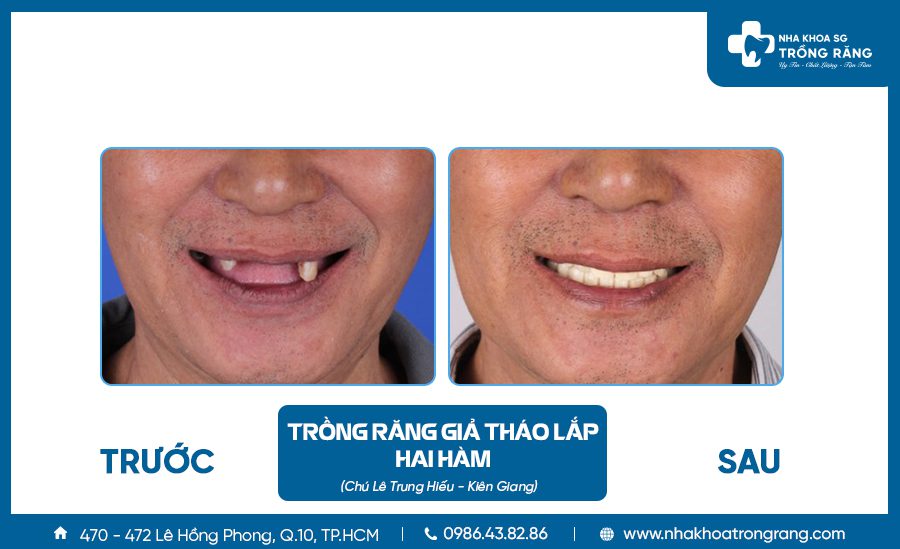 Trồng răng giả tháo lắp - Ưu đãi lên đến【-50%】chi phí