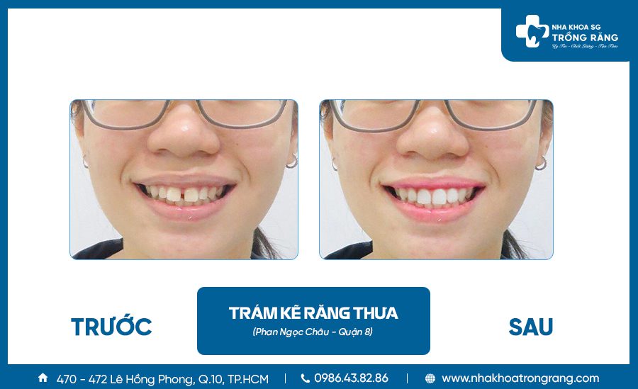 tram ke rang thua Trám răng sâu, trám răng thẩm mỹ - Ưu đãi lên đến【-50%】chi phí
