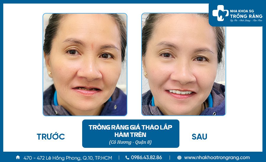 Trồng răng giả tháo lắp - Ưu đãi lên đến【-50%】chi phí