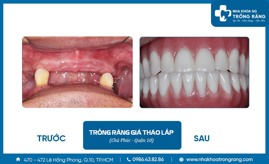 Trồng răng giả tháo lắp - Ưu đãi lên đến【-50%】chi phí