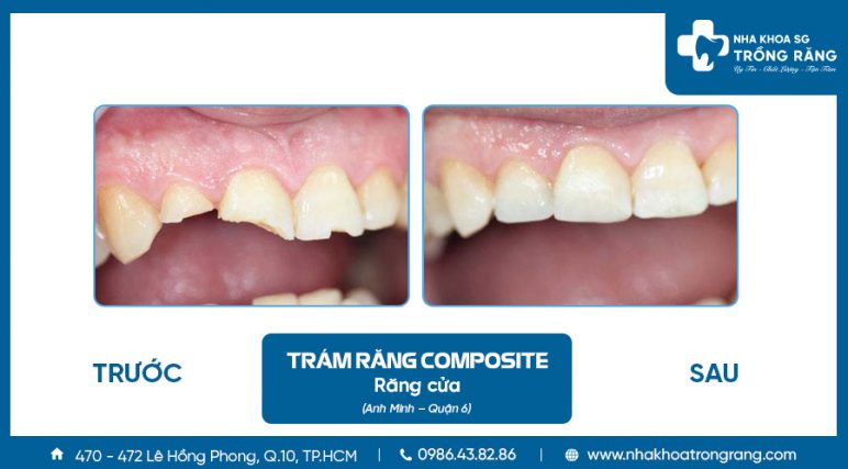 Anh Minh trám răng cửa bị mẻ