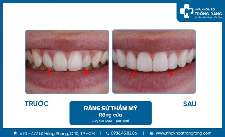 Bọc răng sứ cho các răng cửa đều nhau